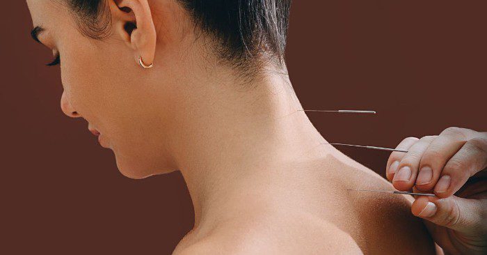It is vital that you choose an experienced acupuncturist.
