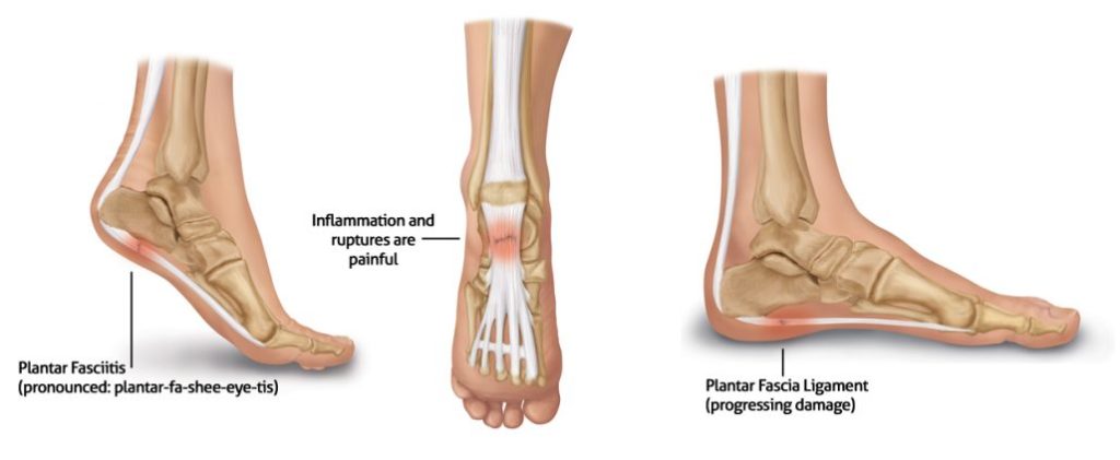 P fasciitis