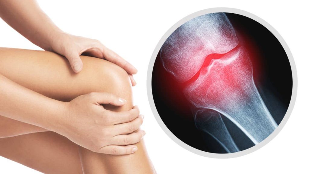 An image showing the effects of osteoarthritis on joints, including inflammation and cartilage damage.