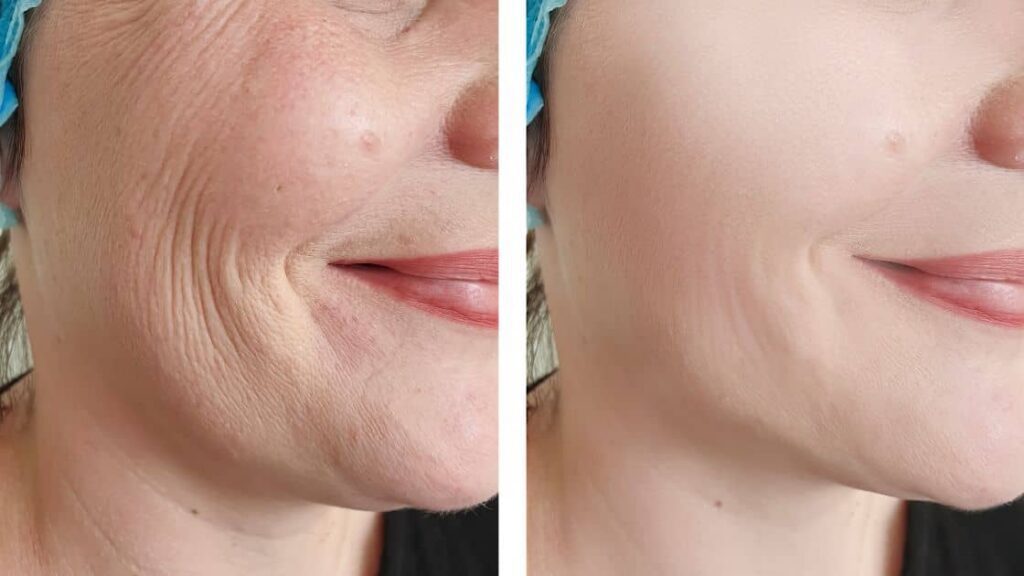 A woman receiving a facial massage to reduce wrinkles and fine lines